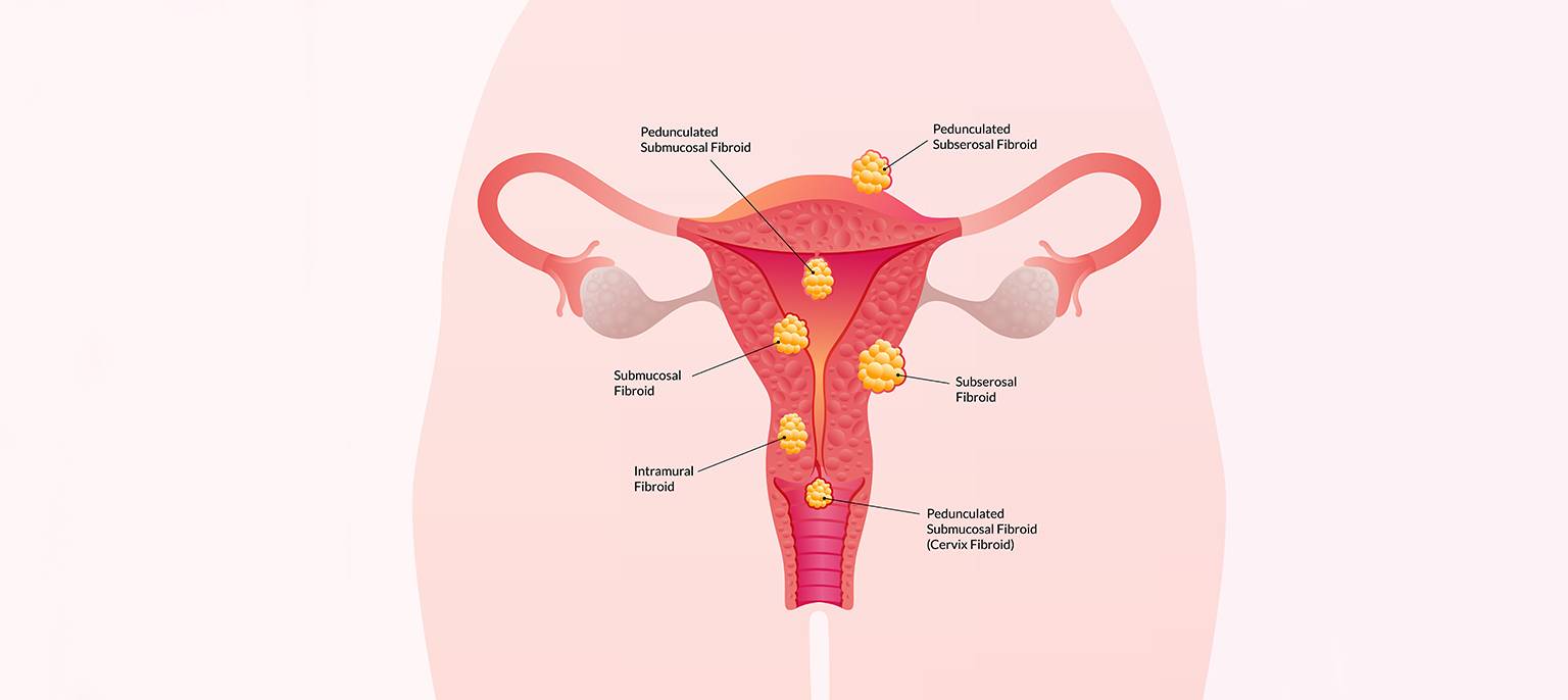 Uterine Fibroids