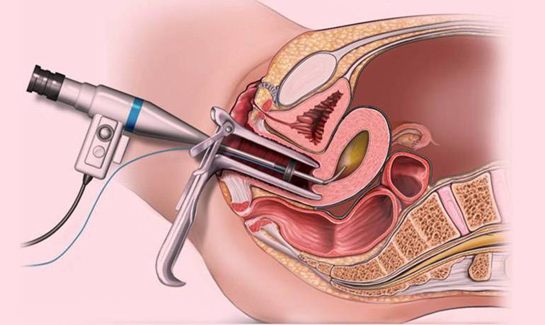 Hysteroscopy