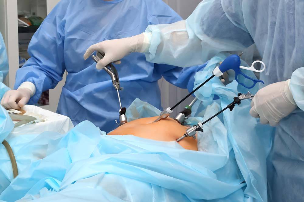 What to expect before, during, and after laparoscopy?